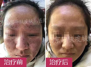 【康复纪实】六年慢性湿疹脸，华肤半月换新颜